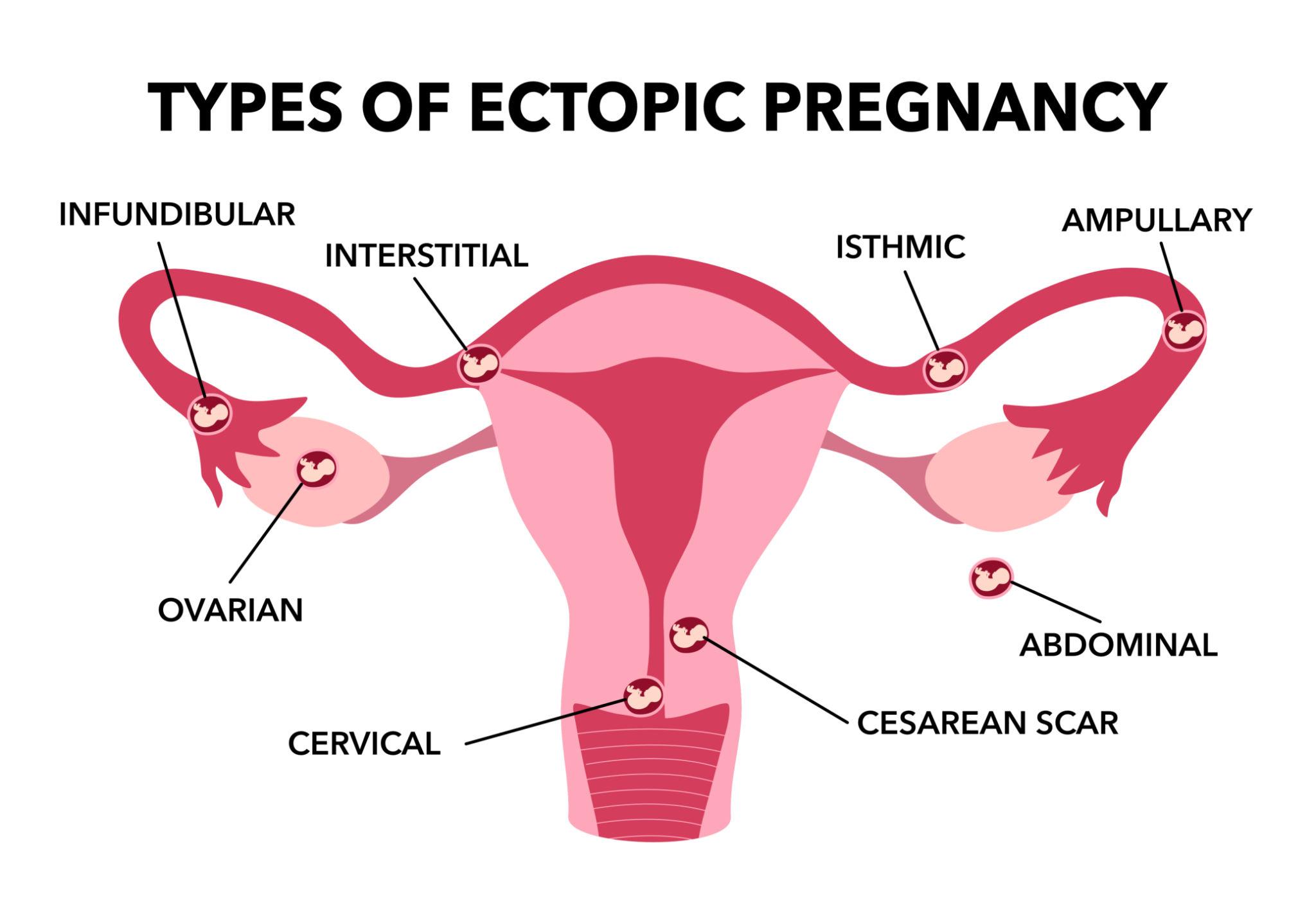 Robotic Ectopic Pregnancy Surgery in Pune – Advanced & Safe Treatment